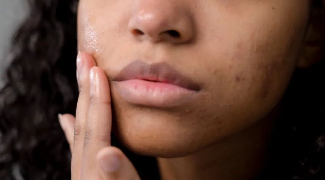 6. Removing Dark Spots  Acne Prone & Sensitive